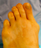 Lubbock Corrective Bunion Surgery
