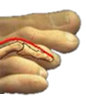 Lubbock Corrective hammertoe Surgery